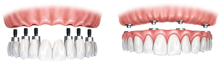 Implant-Dentures -South-Tampa-Florida