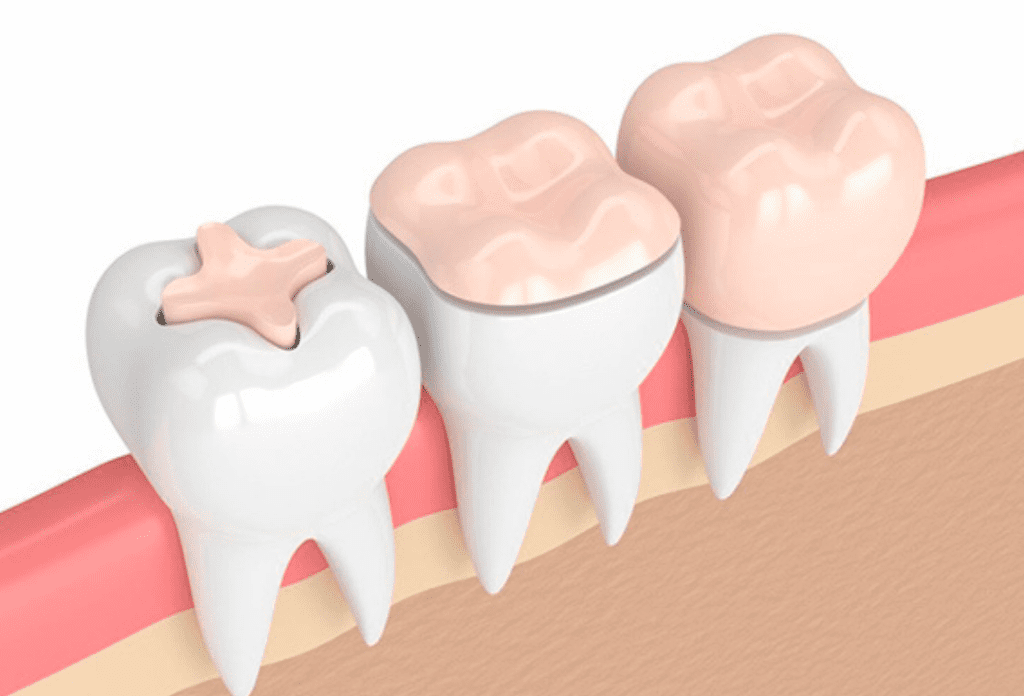 Dental-Crowns-South-Tampa-Dentist