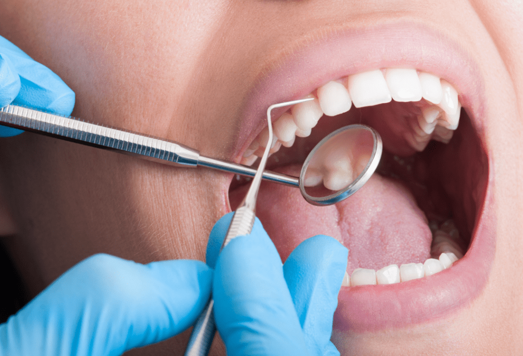 Teeth-Cleaning-South-Tampa-Dentist